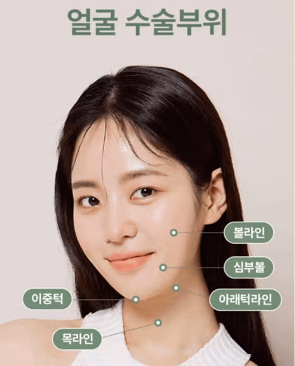 얼굴지방흡입붓기 ,, 어느정도에요?? 심한가? 