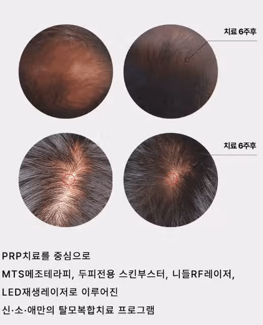 남편의 두피탈모 걱정되는데,, 어떡하죠? 