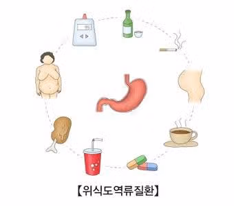 (꿀팁) 역류성식도염 예방하는방법