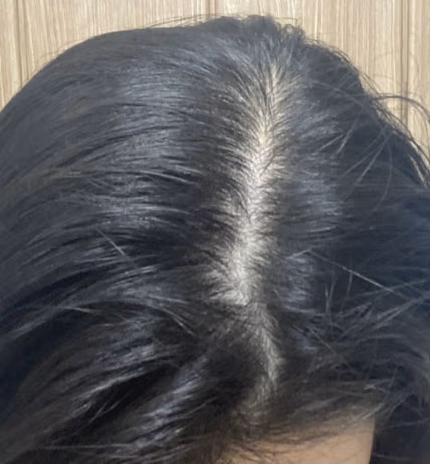 탈모고민을 해결해줄 탈모샴푸 공유해요