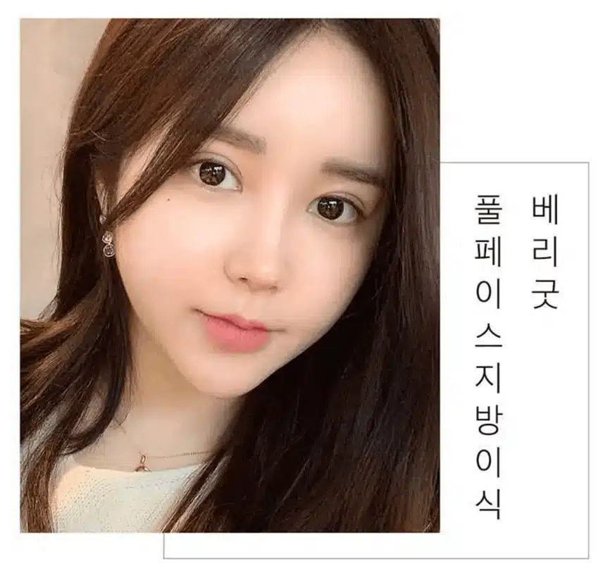 이마지방이식가격 비싼가요? 