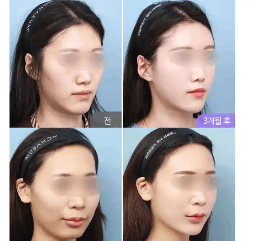 눈꺼풀지방이식으로 처진 거 개선해볼까합니다. 