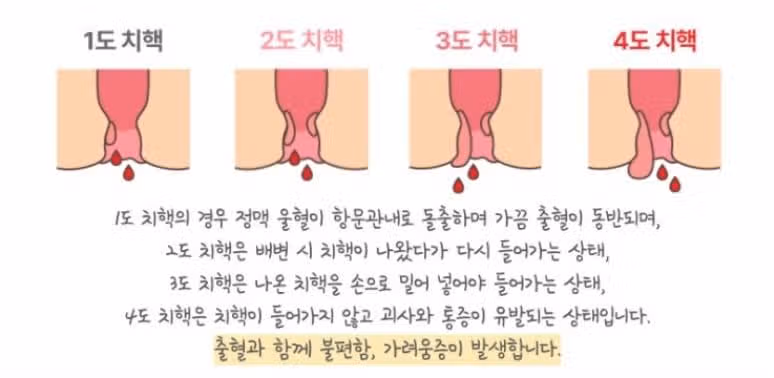 (후기) 치질 수술하지 않고 치료하기