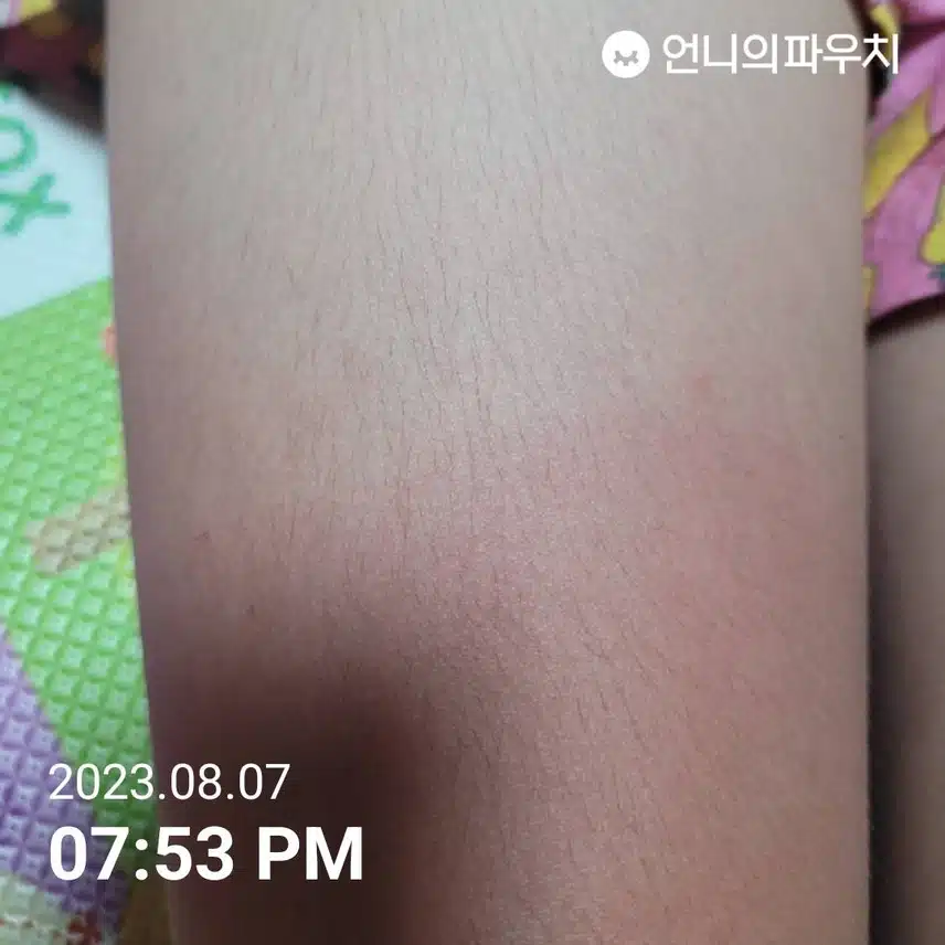 피부가 탔어요ㅠ