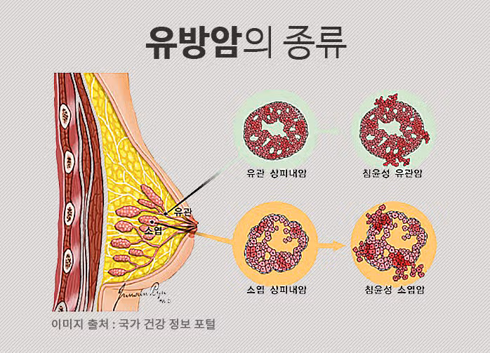 (후기) 건강검진의 중요성-누구나 암에 걸릴 수 있다.