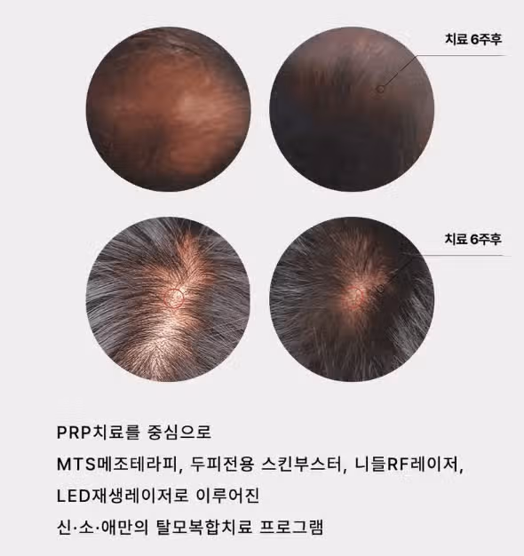 탈모 진단 받으면 관리 방법,, 어떤게 있을까요?? 