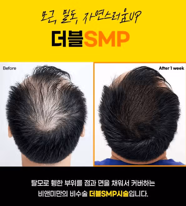 탈모 진단 받으면 관리 방법,, 어떤게 있을까요?? 