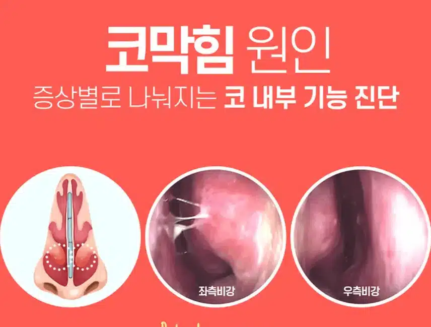 압구정 코성형 병원 찾아요:) 캐시닥 병원 추천좀요 