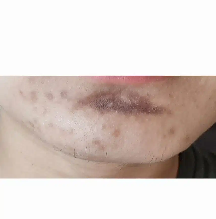 기미등 피부착색을 바꿀수 있을까요??