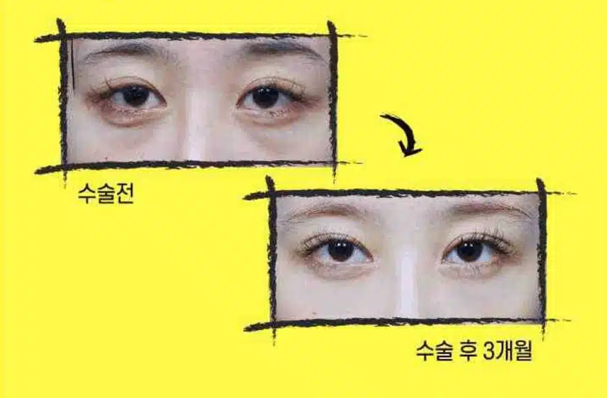 남자 눈밑 지방재배치 잘하는 병원 알려주세요! 
