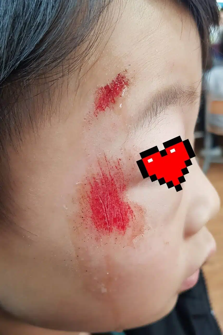 [후기]남아들은 학교에서 연락이 오면 무섭습니다 성형외과 상처 치료 후기에요
