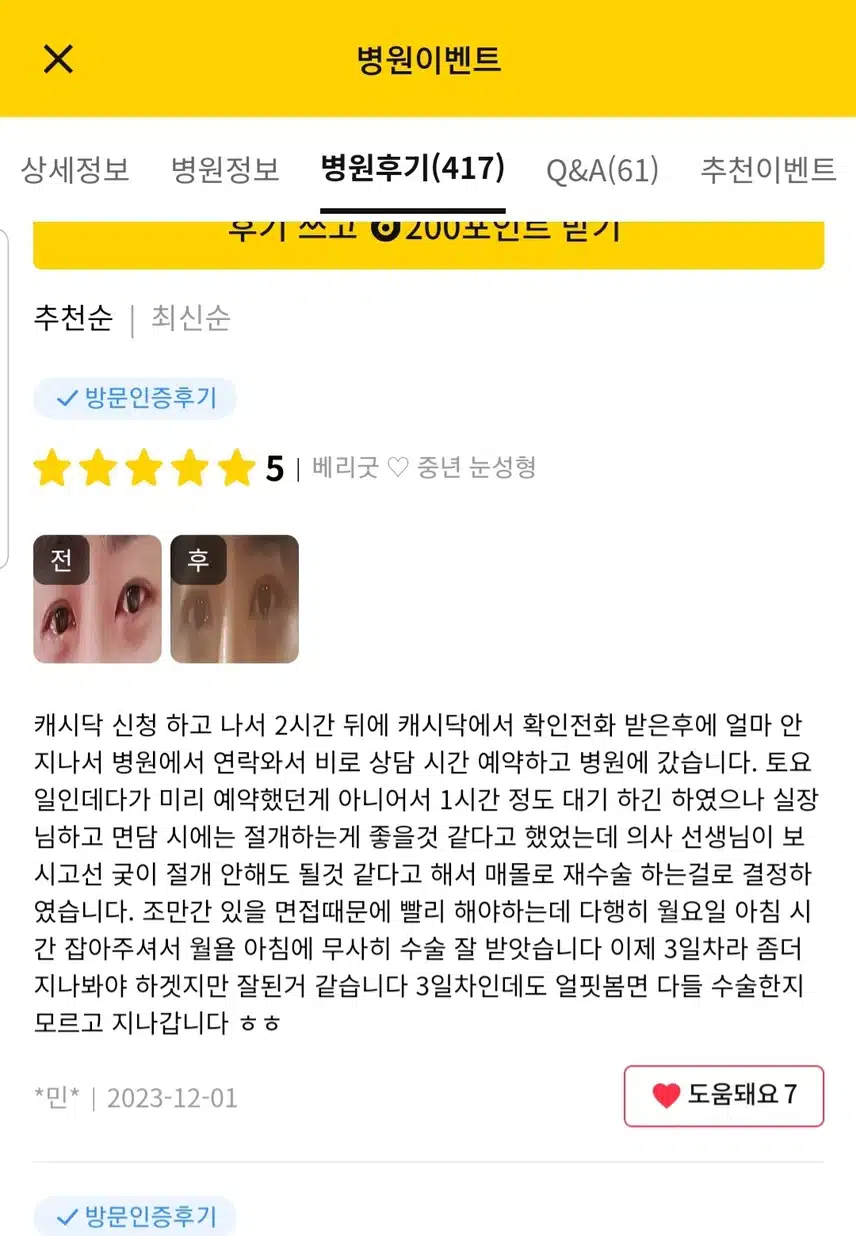 상하검 중년눈성형 시술 후기 추천해요
