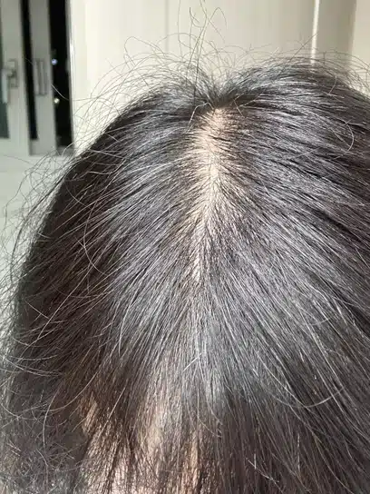 탈모로 인한 제 머리...어떻게 하면 다시 풍성해져 자신감 생길 수 있을까요?