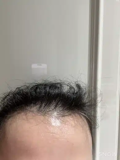 탈모로 인한 제 머리...어떻게 하면 다시 풍성해져 자신감 생길 수 있을까요?