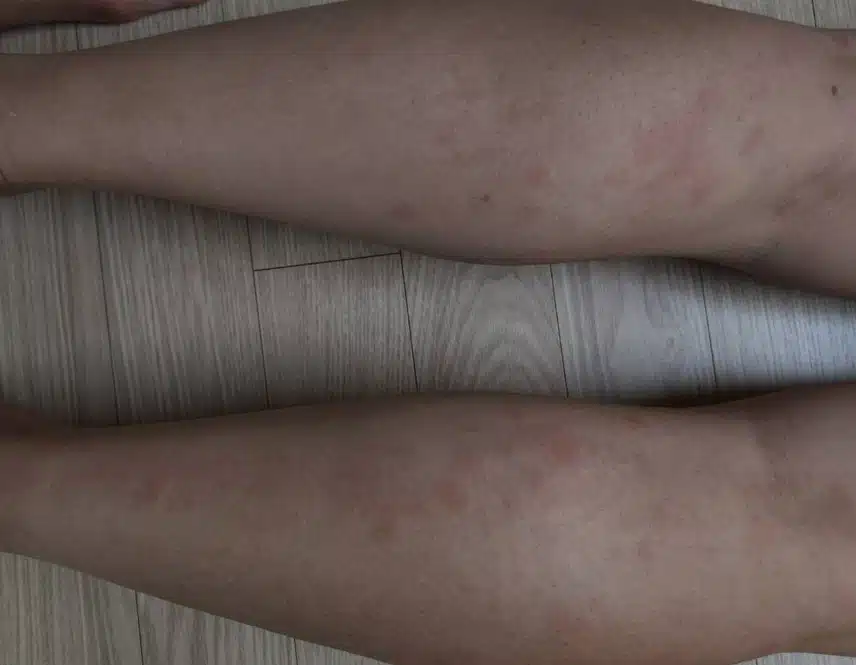 화명동 다미안피부과에서 두드러기 치료했어요.