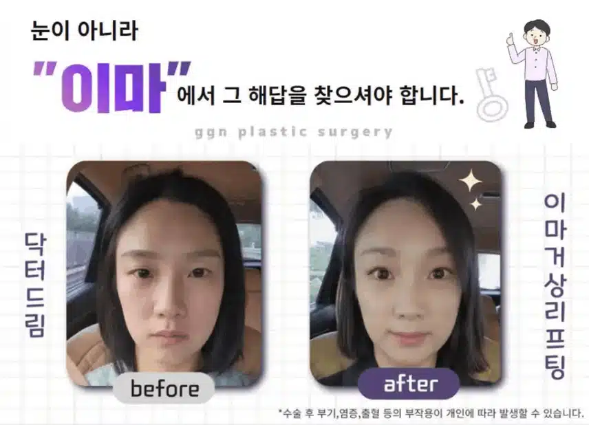 이마 리프팅 해보세요~ 하면 진짜 삶의 질이 달라져요!