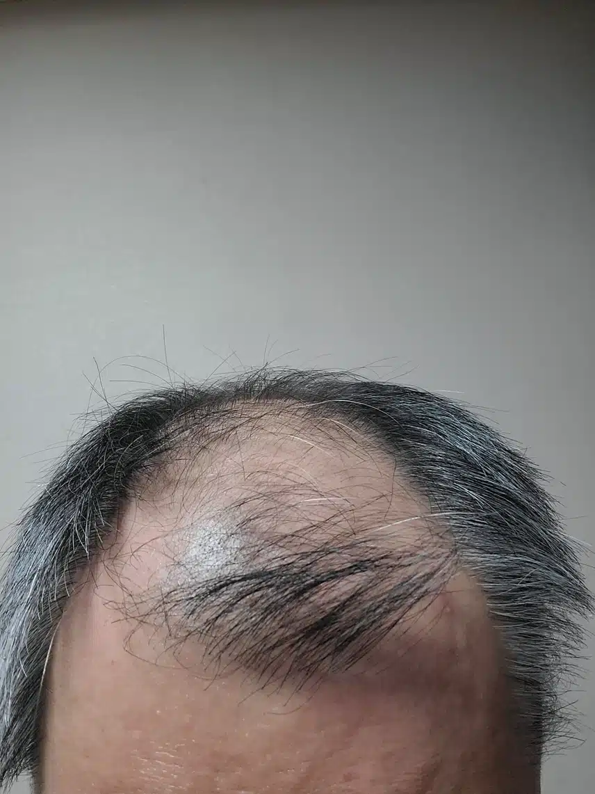 이정도 탈모면 가발 밖에는 답이 없는 건가요?