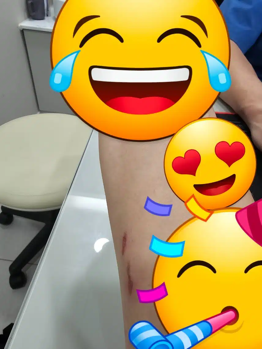 [치료후기] 진 한방병원에서 화상치료 받았어요