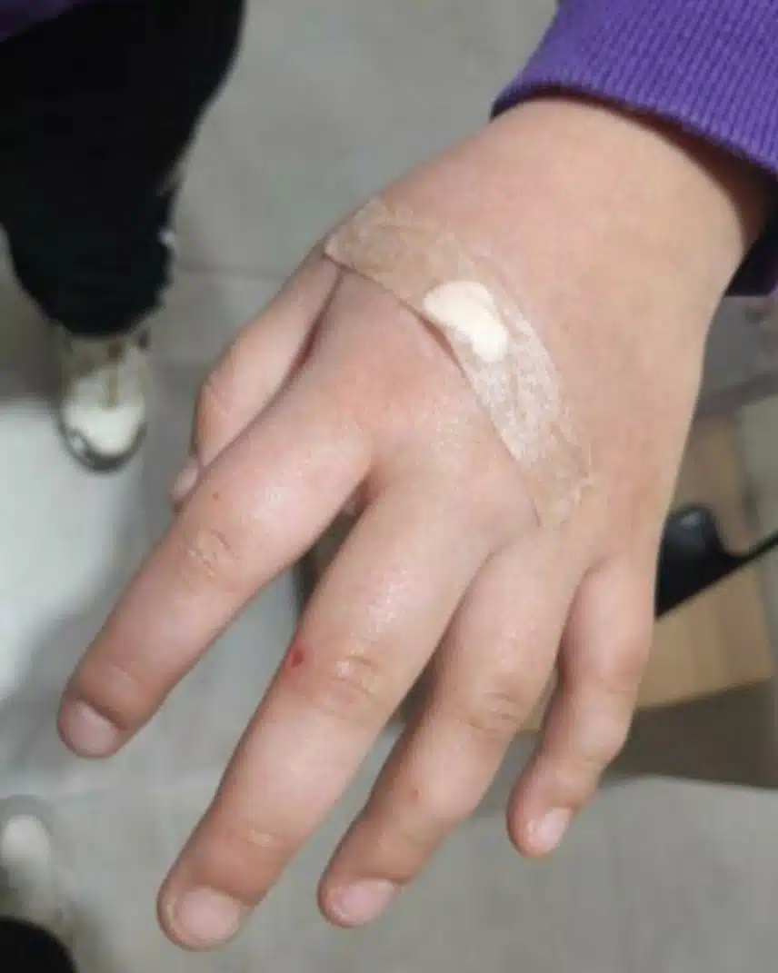 비립종과 색소침착 제거 