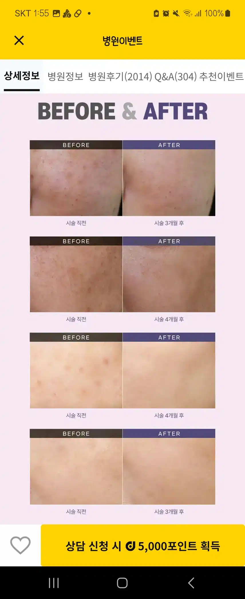 서초미케이의원 색소지우개 (에이톤레이져)후기추천해요