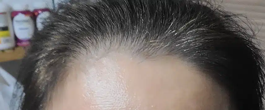 이마가 너무 넓어졌어요ㅠ