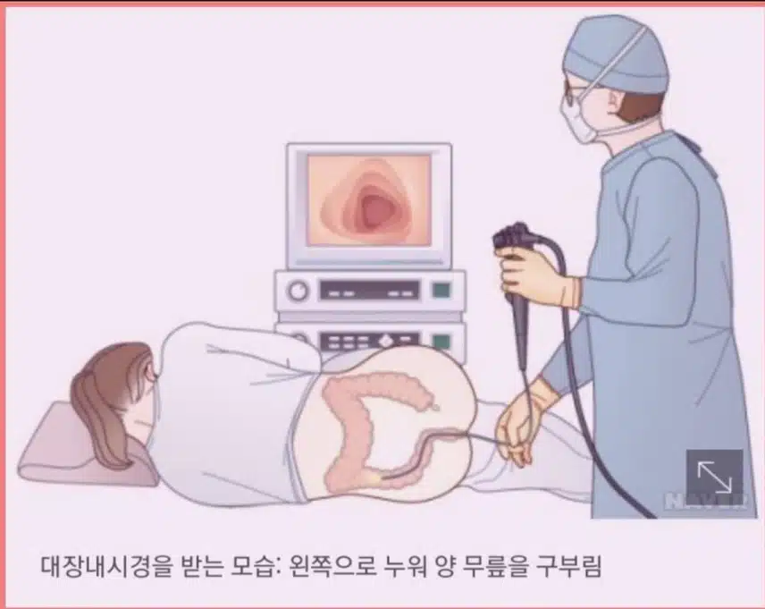 위 대장 내시경후 용종제거 했어요.