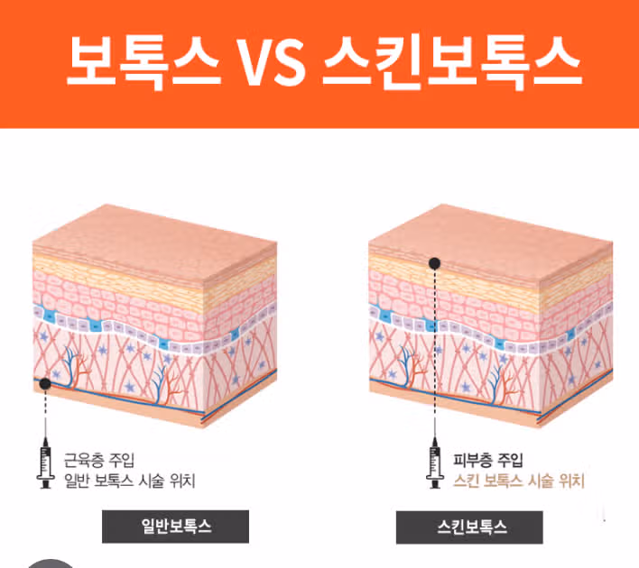 스킨보톡스 후기입니다. 피부 텐션이 살아나요 ㅎㅎ 