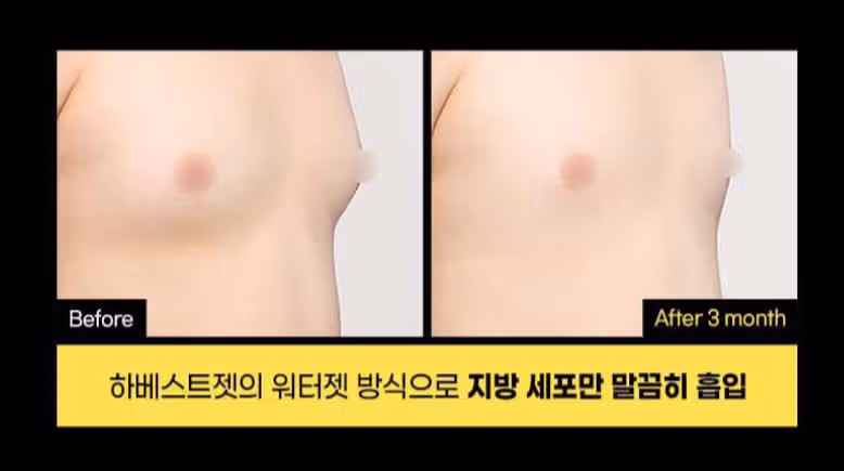 [고민] 이정도도 남성여유증인가요?