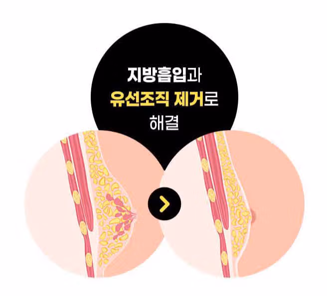 [고민] 이정도도 남성여유증인가요?