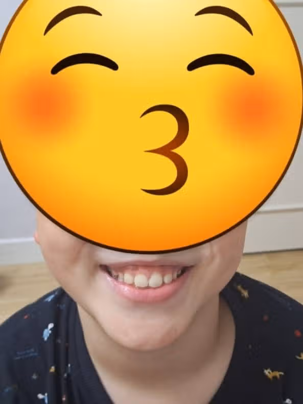 [질문] 잇몸성형 언제가 좋을까요?