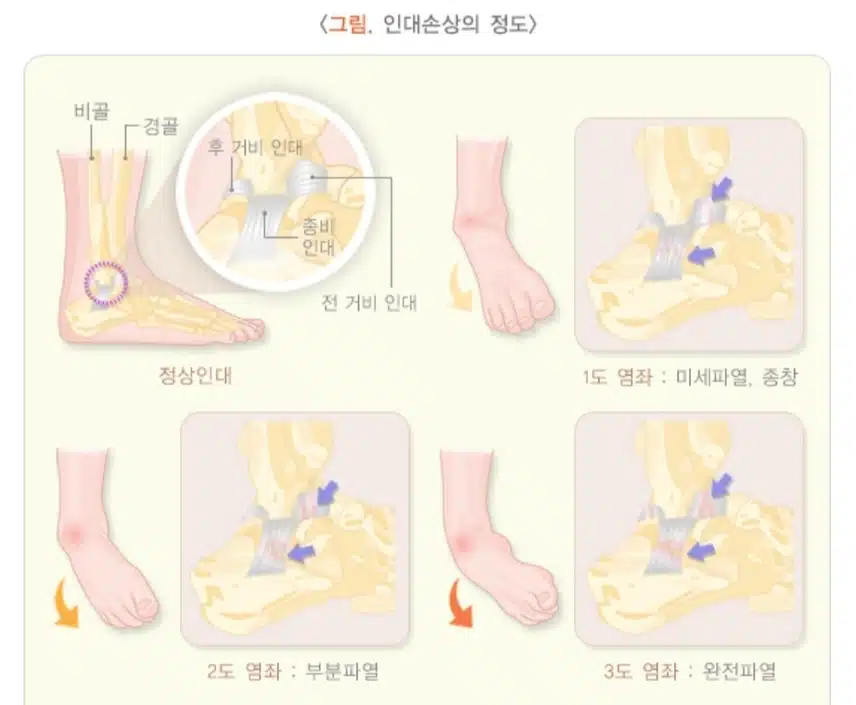 염좌