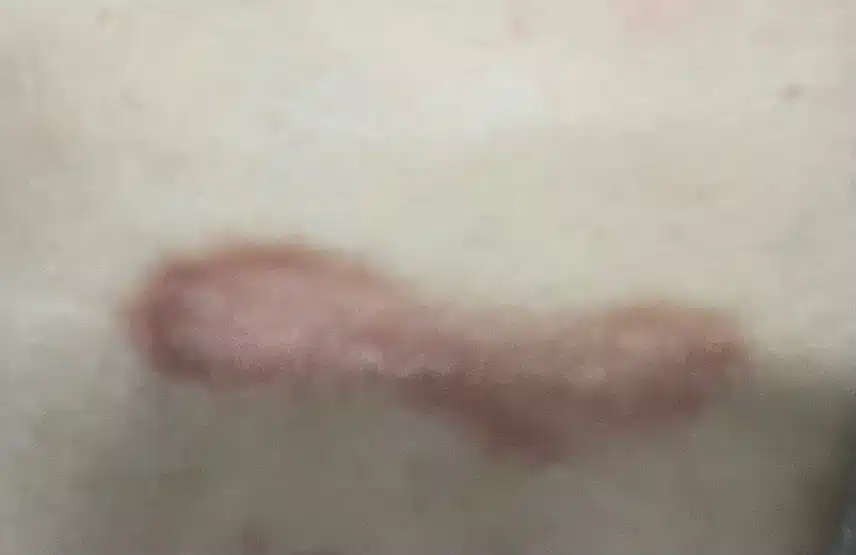 (고민) 피부에 뭔가 있는데 이건 뭔가요??