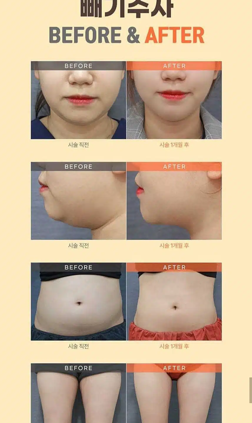 미케이의원 빼기 주사 이벤트 추천합니다