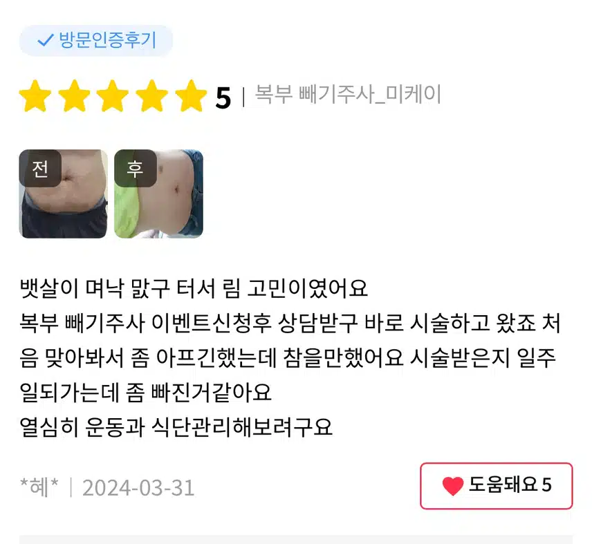 미케이의원 빼기 주사 이벤트 추천합니다