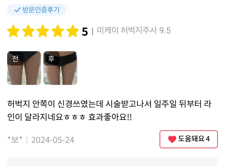 미케이의원 빼기 주사 이벤트 추천합니다