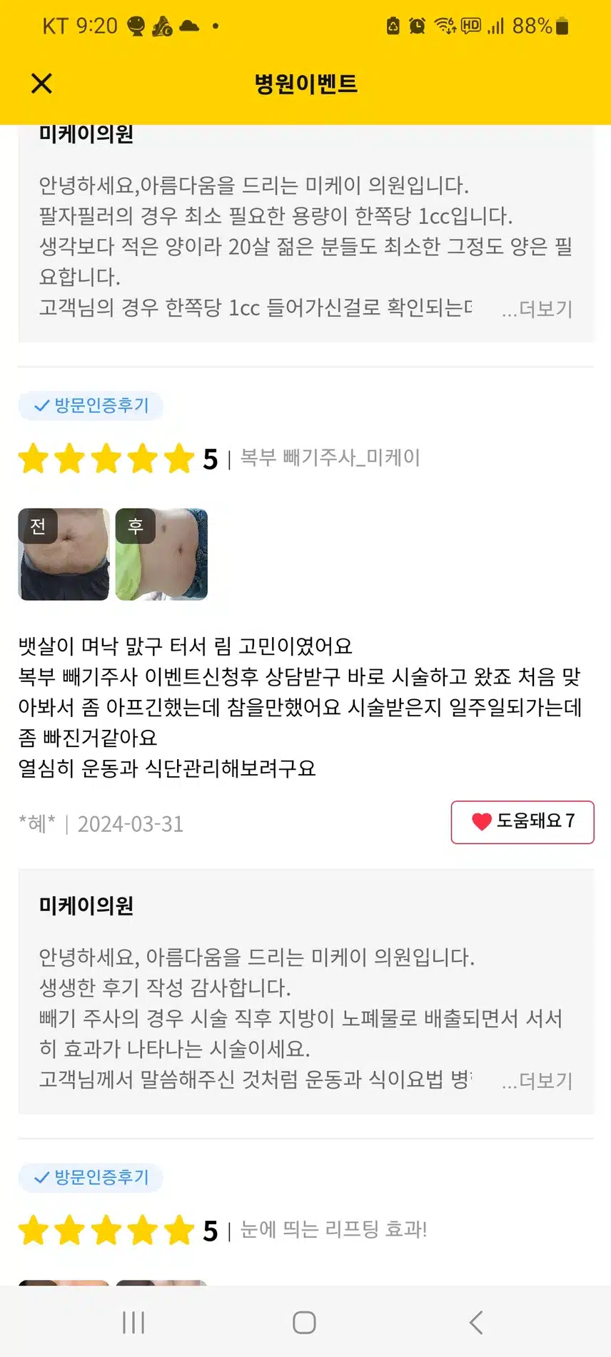 미케이 의원   빼기주사.