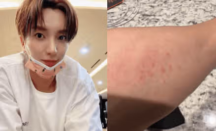 대상포진 걸리는 #가지 이유