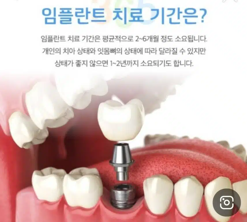 임플란트 젊은 사람도 하나요?
