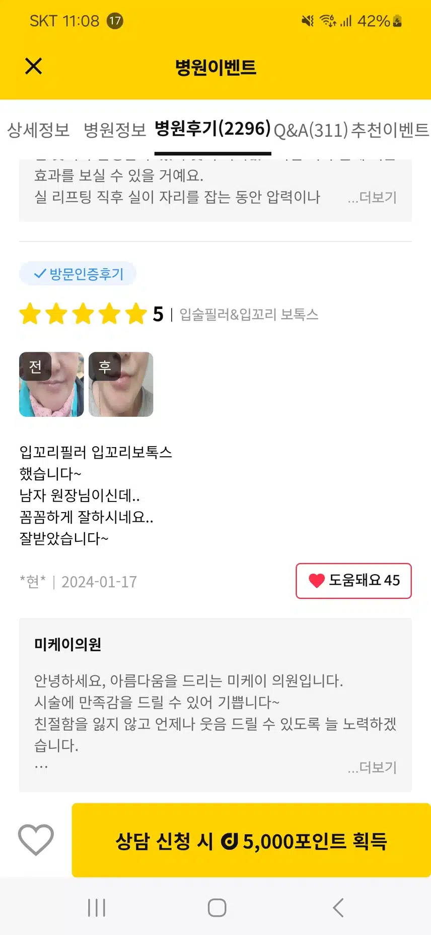미케이의원 입꼬리필러와 보톡스 시술 후기: 꼼꼼한 남자 원장님 덕분에 만족스러운 결과! (도움되어요를 누른 이유)