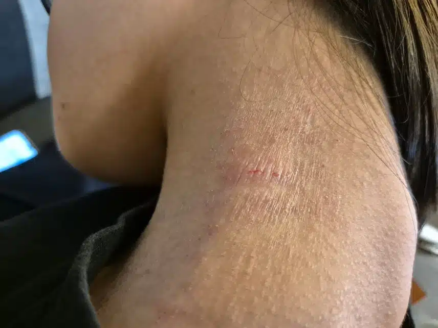 대구 달성피부과에서 아토피치료 받고 있어요