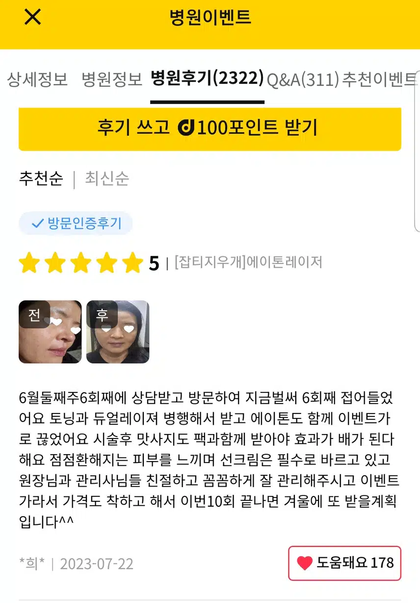 [미케이의원] 팔자필러 시술 후기를 리뷰 및 추천합니다!