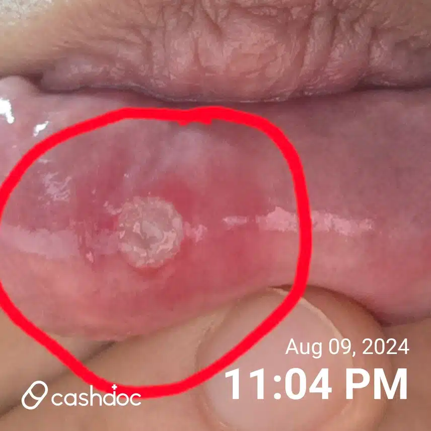 8/9(금)입안 하얀 구내염...염증 빨리 낫는법 있을까요?(ToT)