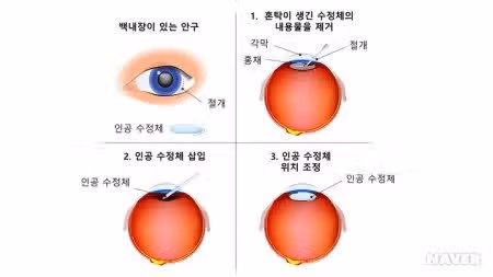 나이가 들어 가면서 눈이 침침해지고 백내장 등 눈 건강 걱정되요
