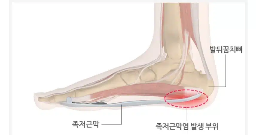 아침에 일어나면 발뒤꿈치 저림현상이 있어요.