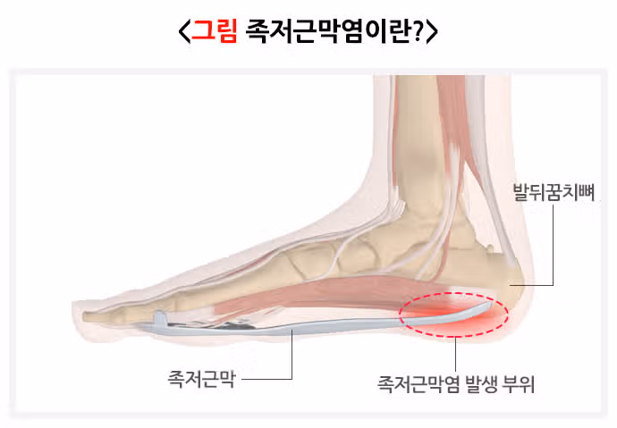 갑자기 발뒷꿈치에 통증이 있어요