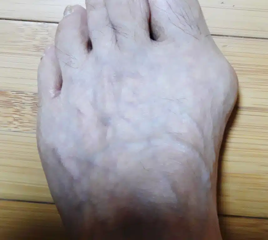 [고민] 무지외반증에 통풍 통증까지 겹쳤어요