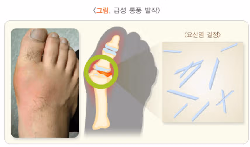 통풍 자가진단 해보세요 초기 치료 필수입니다!