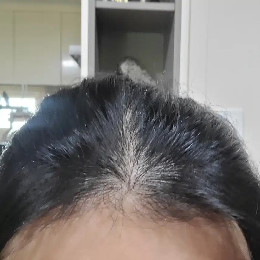 출산 후 시작된 탈모 너무 고민되요.