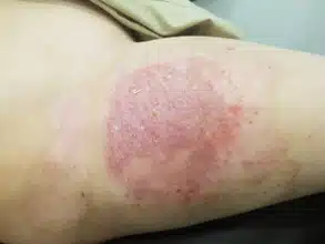 한의원에서 아들의 화상치료 후기