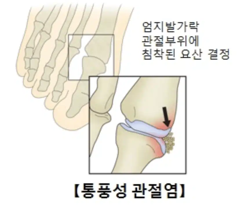 통풍 치료 민간요법 정말로 효과 있을까? (팩트체크)